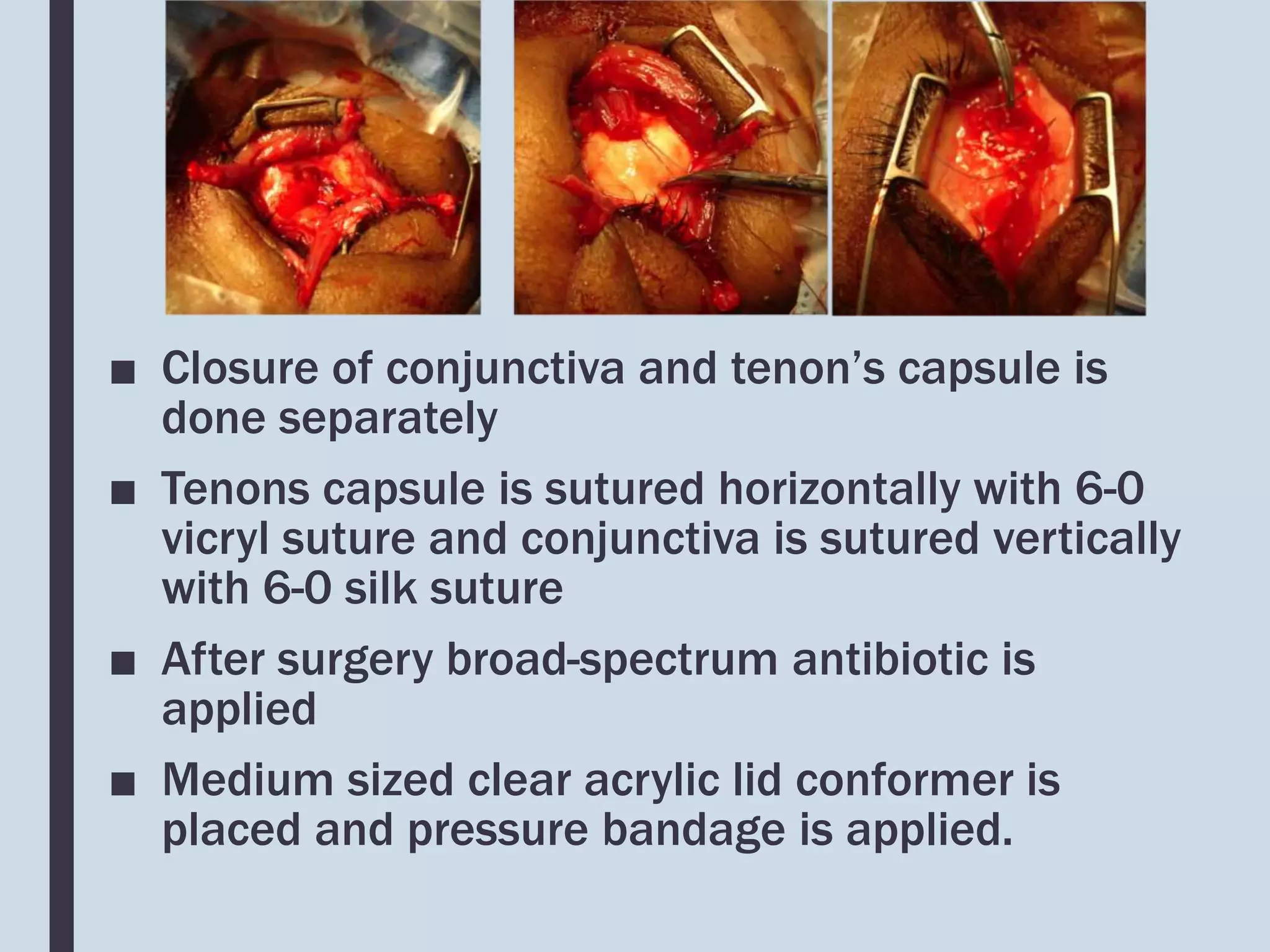 ■ Closure of conjunctiva and tenon’s capsule is
done separately
■ Tenons capsule is sutured horizontally with 6-0
vicryl suture and conjunctiva is sutured vertically
with 6-0 silk suture
■ After surgery broad-spectrum antibiotic is
applied
■ Medium sized clear acrylic lid conformer is
placed and pressure bandage is applied.
 