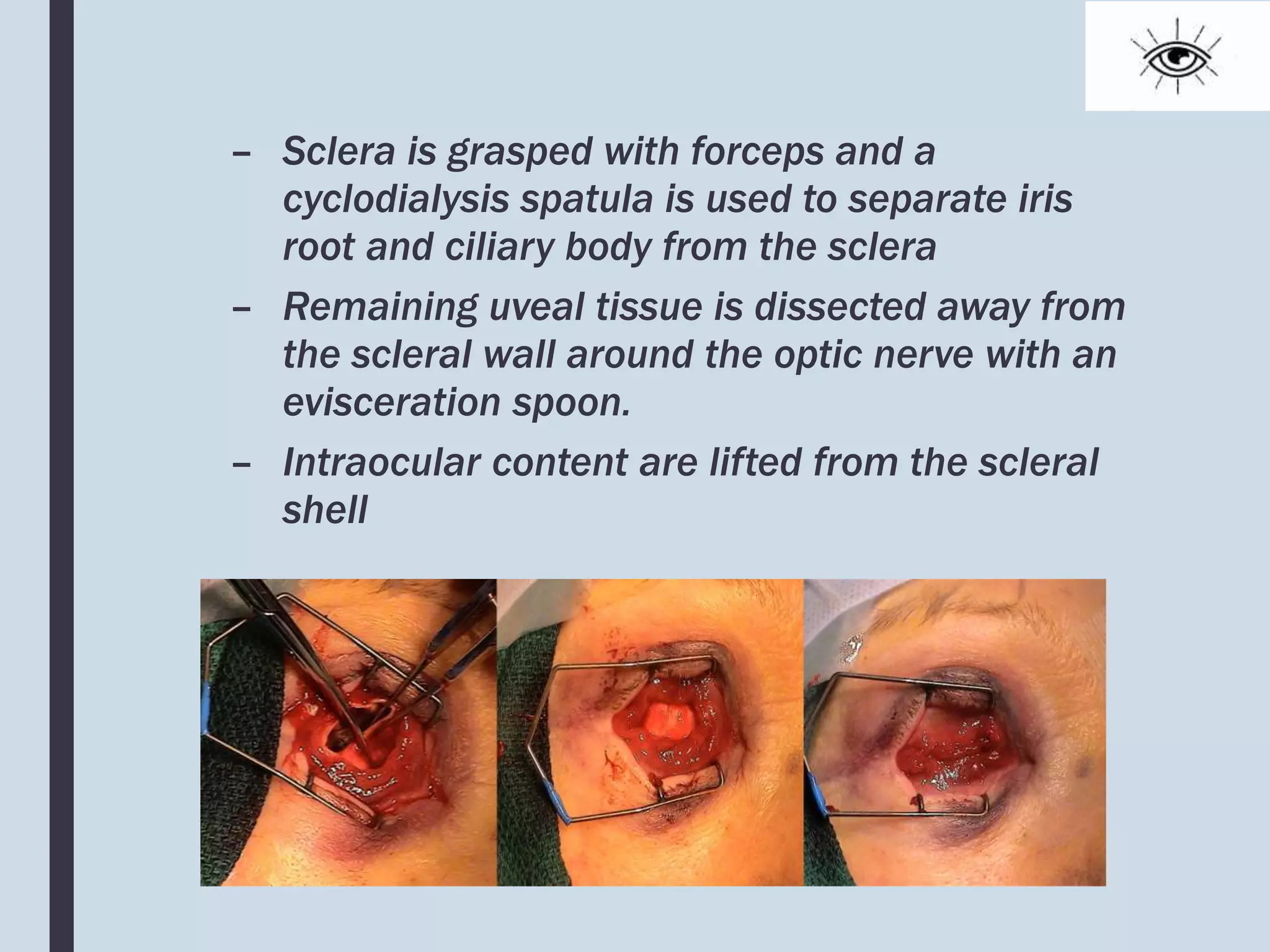 – Sclera is grasped with forceps and a
cyclodialysis spatula is used to separate iris
root and ciliary body from the sclera
– Remaining uveal tissue is dissected away from
the scleral wall around the optic nerve with an
evisceration spoon.
– Intraocular content are lifted from the scleral
shell
 