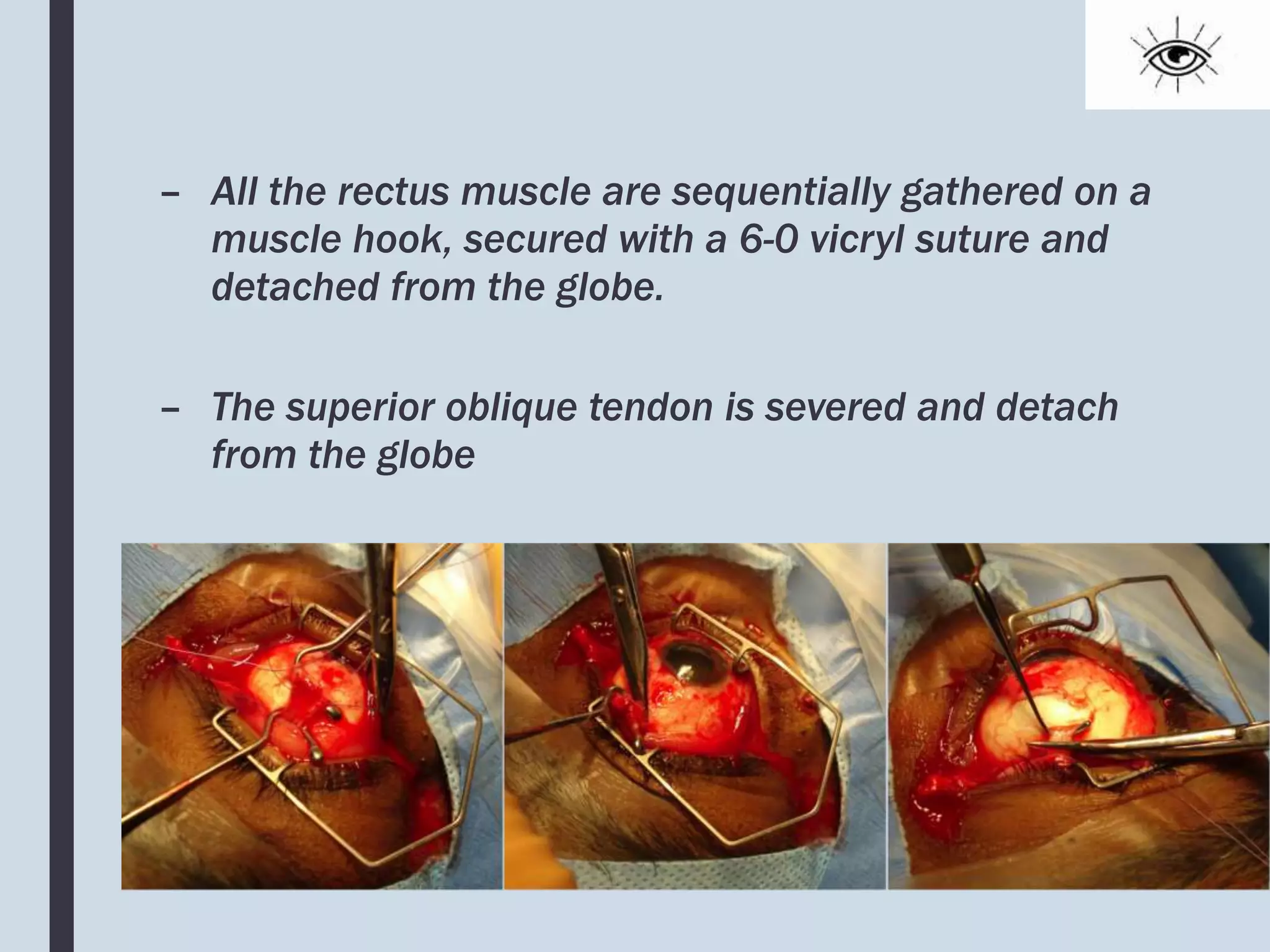 – All the rectus muscle are sequentially gathered on a
muscle hook, secured with a 6-0 vicryl suture and
detached from the globe.
– The superior oblique tendon is severed and detach
from the globe
 