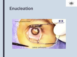 Auto Enucleation Enucleation and evisceration | PPTX