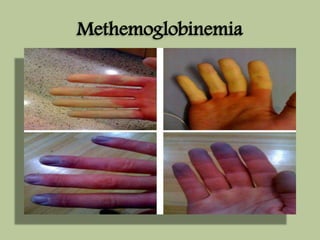 Methemoglobinemia 
 