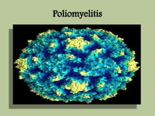 Poliomyelitis 
 