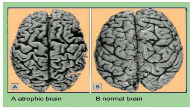 • Gráfico computarizado de un corte
vertical (coronal) del cerebro de un
paciente con Alzheimer (izquierda) en
comparación...
