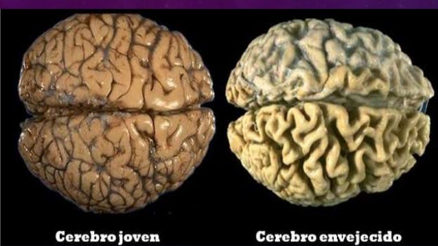 • se produce una pérdida de mielina y una
disminución en el volumen de la sustancia
gris, lo que conlleva un ensanchamient...