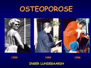 OSTEOPOROSE
19591959 1996199619891989
INGER LUNDEGAARDH
 
