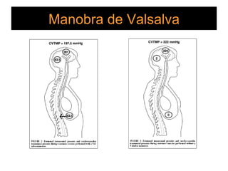 Manobra de Valsalva 