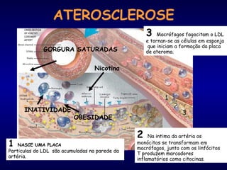 ATEROSCLEROSE
1 NASCE UMA PLACA
Particulas do LDL são acumuladas na parede da
artéria.
2 Na intima da artéria os
monócitos se transformam em
macrófagos, junto com os linfócitos
T produzem marcadores
inflamatórios como citocinas.
3 Macrófagos fagocitam o LDL
e tornan-se as células em esponja
que iniciam a formação da placa
de ateroma.GORGURA SATURADAS
Nicotina
INATIVIDADE
OBESIDADE
 