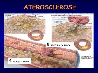 4 PLACA FIBROSA
5 RUPTURA DA PLACA
ATEROSCLEROSE
 
