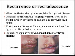 0 When reactivated virus produces clinically apparent disease.

0 Experience paresthesiae (tingling, warmth, itch) on the

site followed by erythema and a papule usually with in 24
hours.
0 Most common site are at the mucocutaneous junction of the
lip, on the chin or inside the nose.
0 Lesions are popularly known as “cold sores” or “fever
blisters”

First time

recurrence

 
