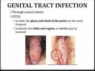 0 Through sexual contact
0 SITES:
0 In male: the glans and shaft of the penis are the most
frequent
0 In female: the labia and vagina, or cervix may be
involved

 