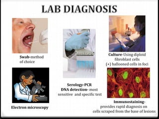 Culture-Using diploid
fibroblast cells
(+) ballooned cells in foci

Swab-method
of choice

Serology-PCR
DNA detection- most
sensitive and specific test
Electron microscopy

Immunostainingprovides rapid diagnosis on
cells scraped from the base of lesions

 