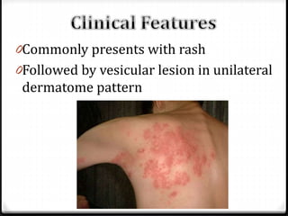 0Commonly presents with rash
0Followed by vesicular lesion in unilateral

dermatome pattern

 