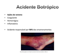•   Ações do veneno:
•   Coagulante
•   Hemorrágica
•   Inflamatória

• Acidente responsável por 90% dos envenenamentos




                 http://www.google.com.br/imgres?q=picada+de+cobra+jararaca&start=10&num=
 