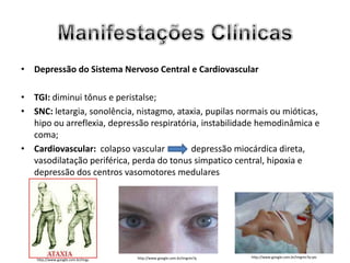 • Depressão do Sistema Nervoso Central e Cardiovascular

• TGI: diminui tônus e peristalse;
• SNC: letargia, sonolência, nistagmo, ataxia, pupilas normais ou mióticas,
  hipo ou arreflexia, depressão respiratória, instabilidade hemodinâmica e
  coma;
• Cardiovascular: colapso vascular         depressão miocárdica direta,
  vasodilatação periférica, perda do tonus simpatico central, hipoxia e
  depressão dos centros vasomotores medulares




                                    http://www.google.com.br/imgres?q   http://www.google.com.br/imgres?q=pic
    http://www.google.com.br/imgc
 