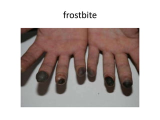 frostbite
 