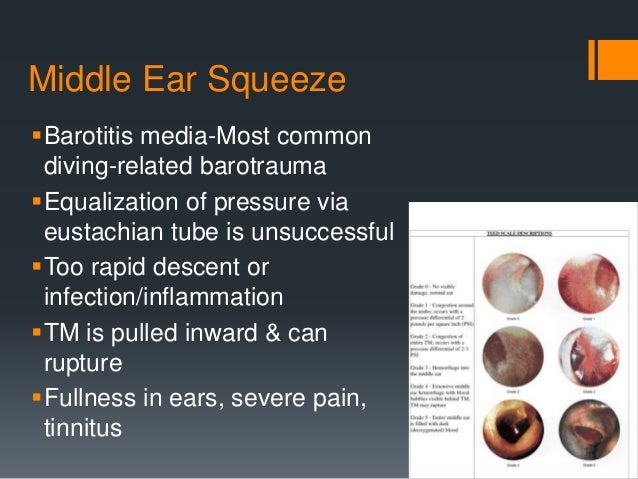 barotrauma otic barotrauma otic