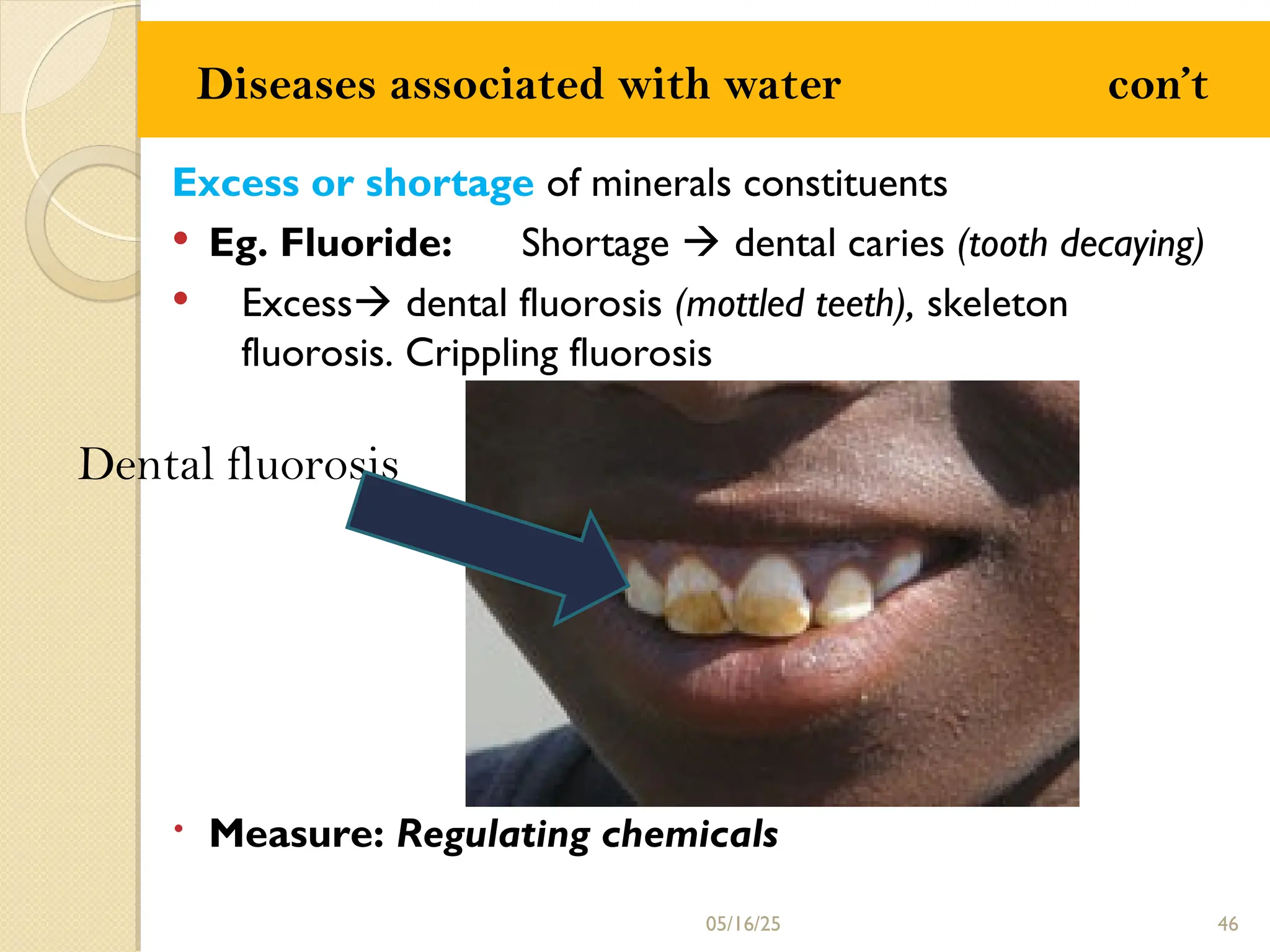 Excess or shortage of minerals constituents
 Eg. Fluoride: Shortage  dental caries (tooth decaying)
 Excess dental fluorosis (mottled teeth), skeleton
fluorosis. Crippling fluorosis
 Measure: Regulating chemicals
05/16/25 46
Diseases associated with water con’t
Dental fluorosis
 