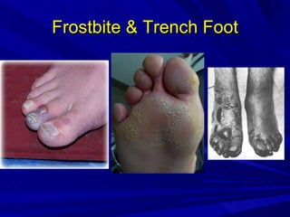 Frostbite & Trench Foot 