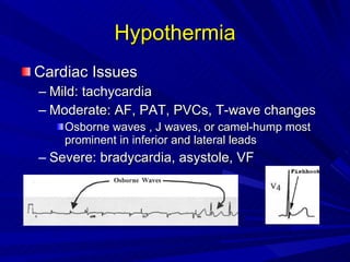 Hypothermia Cardiac Issues Mild: tachycardia Moderate: AF, PAT, PVCs, T-wave changes Osborne waves , J waves, or camel-hump most prominent in inferior and lateral leads Severe: bradycardia, asystole, VF 
