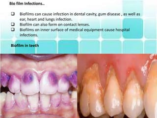 Bio film Infections..
 Biofilms can cause infection in dental cavity, gum disease , as well as
ear, heart and lungs infection.
 Biofilm can also form on contact lenses.
 Biofilms on inner surface of medical equipment cause hospital
infections.
Biofilm in teeth
 
