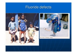 Fluoride defects
Fluoride defects
 