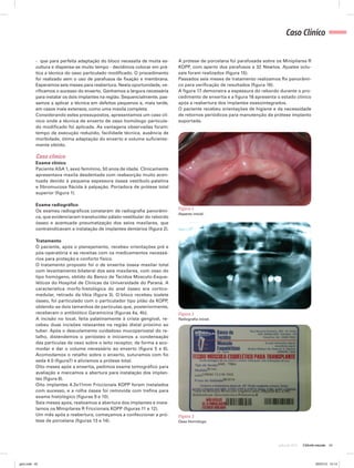 43julho de 2012
Caso Clínico
- que para perfeita adaptação do bloco necessita de muita es-
cultura e dispensa-se muito tempo - decidimos colocar em prá-
tica a técnica do osso particulado modificado. O procedimento
foi realizado sem o uso de parafusos de fixação e membrana.
Esperamos seis meses para reabertura. Nesta oportunidade, ve-
rificamos o sucesso do enxerto. Ganhamos a largura necessária
para instalar os dois implantes na região. Sequencialmente, pas-
samos a aplicar a técnica em defeitos pequenos e, mais tarde,
em casos mais extensos, como uma maxila completa.
Considerando estes pressupostos, apresentamos um caso clí-
nico onde a técnica de enxerto de osso homólogo particula-
do modificado foi aplicada. As vantagens observadas foram:
tempo de execução reduzido, facilidade técnica, ausência de
morbidade, ótima adaptação do enxerto e volume suficiente-
mente obtido.
Caso clínico
Exame clínico
Paciente ASA 1, sexo feminino, 50 anos de idade. Clinicamente
apresentava maxila desdentada com reabsorção muito acen-
tuada devido à pequena espessura óssea vestíbulo-palatina
e fibromucosa flácida à palpação. Portadora de prótese total
superior (figura 1).
Exame radiográfico
Os exames radiográficos constaram de radiografia panorâmi-
ca, que evidenciaram translucidez pálato-vestibular do rebordo
ósseo e acentuada pneumatização dos seios maxilares, que
contraindicavam a instalação de implantes dentários (figura 2).
Tratamento
O paciente, após o planejamento, recebeu orientações pré e
pós-operatória e as receitas com os medicamentos necessá-
rios para proteção e conforto físico.
O tratamento proposto foi o de enxertia óssea maxilar total
com levantamento bilateral dos seis maxilares, com osso do
tipo homógeno, obtido do Banco de Tecidos Músculo-Esque-
léticos do Hospital de Clínicas da Universidade do Paraná. A
característica morfo-histológica do anel ósseo era cortico-
medular, retirado da tíbia (figura 3). O bloco recebeu toalete
ósseo, foi particulado com o particulador tipo pilão da KOPP,
obtendo-se dois tamanhos de partículas que, posteriormente,
receberam o antibiótico Garamicina (figuras 4a, 4b).
A incisão no local, feita palatinamente à crista gengival, re-
cebeu duas incisões relaxantes na região distal próximo ao
tuber. Após o descolamento cuidadoso mucoperiostal do re-
talho, distendemos o periósteo e iniciamos a condensação
das partículas de osso sobre o leito receptor, de forma a aco-
modar e dar o volume necessário ao enxerto (figura 5 e 6).
Acomodamos o retalho sobre o enxerto, suturamos com fio
seda 4.0 (figura7) e aliviamos a prótese total.
Oito meses após a enxertia, pedimos exame tomográfico para
avaliação e marcamos a abertura para instalação dos implan-
tes (figura 8).
Oito implantes 4.3x11mm Friccionais KOPP foram instalados
com sucesso, e a rolha óssea foi removida com trefina para
exame histológico (figuras 9 e 10).
Seis meses após, realizamos a abertura dos implantes e insta-
lamos os Minipilares R Friccionais KOPP (figuras 11 e 12).
Um mês após a reabertura, começamos a confeccionar a pró-
tese de porcelana (figuras 13 e 14).
A prótese de porcelana foi parafusada sobre os Minipilares R
KOPP, com aperto dos parafusos a 32 Newtos. Ajustes oclu-
sais foram realizados (figura 15).
Passados seis meses de tratamento realizamos Rx panorâmi-
co para verificação de resultados (figura 16).
A figura 17 demonstra a espessura do rebordo durante o pro-
cedimento de enxertia e a figura 18 apresenta o estado clínico
após a reabertura dos implantes osseointegrados.
O paciente recebeu orientações de higiene e da necessidade
de retornos periódicos para manutenção da prótese implanto
suportada.
Figura 1
Aspecto inicial.
Figura 2
Radiografia inicial.
Figura 3
Osso Homólogo.
gino.indd 43 20/07/12 15:14
 