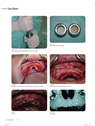 44 julho de 2012
Caso Clínico
Figura 4a
Osso Homólogo sendo particulado em moedor tipo pilão.
Figura 4b
Dois tipos de partículas obtidas.
Figura 5
Rebatimento da fibromucosa com exposição do rebordo osso atrésico.
Figura 7
Sutura.
Figura 6
Acomodamento das partículas sobre o rebordo.
Figura 8
Tomografia.
gino.indd 44 20/07/12 15:14
 