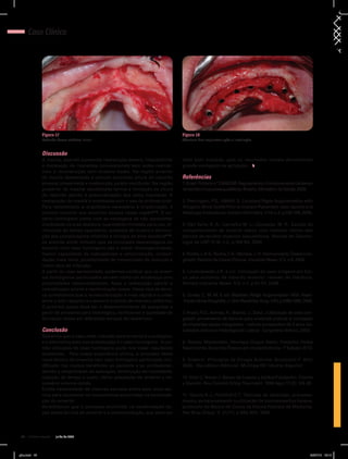 46 julho de 2012
Caso Clínico
mais bem avaliada, pois os resultados iniciais demonstram
grande vantagem na aplicação.
Referências
1.Brasil.Portarian.º2.600/GM.Regulamentaofuncionamentodebanco
detecidosmusculoesqueléticos.Brasília,MinistériodaSaúde,2009.
2. Petrungaro, P.S.; AMAR, S. Localized Rigde Augmentation with
Allogenic Block Grafts Prior to Implant Placement: case reports and
Histologic Evaluations. Implant Dentristry. V.14, n.2, p.139-148, 2005.
3. Dell Valle, R. A.; Carvalho M. L.; Gonzalez, M. R. Estudo do
comportamento de enxerto ósseo com material obtido dos
bancos de tecidos músculo-esqueléticos. Revista de Odonto-
logia da USP. V.18, n.2, p.189-94, 2006.
4. Rocha, L.R.S.; Rocha, F.A.; Moraes, J. R. Homoenxerto Ósseo Con-
gelado: Relatos de Casos Clínicos. Implante News. V.3, n.6, 2006.
5. Levandowski J.R. e col. Utilização do osso alógeno em blo-
co para aumento de rebordo alveolar: revisão da literatura.
Revista Implante News. V.5, n.1, p.51-57, 2008.
6. Contar, C. M. M. E col. Maxillary Ridge Augmentation With Fresh-
-FrozenBoneAllografts.J.OralMaxillofacSurg.V.67,p.1280-1285,2009.
7. Aracil, R.D.; Alonso, A.; Blanco, J.; Sanz, J.Utilização de osso con-
gelado proveniente de bancos para enxertos prévios à colocação
de implantes ósseo-integrados - estudo prospectivo de 3 anos (re-
sultados clínicos e histológicos). Lisboa: Congresso Ibérico, 2003.
8. Renato Mazzonetto, Henrique Duque Netto, Frederico Felipe
Nascimento, Enxertos Ósseos em Implantodontia. 1ª Edição/ 2012.
9. Scwartz Principios de Cirugía Autor/es: Brunicardi F. Año:
2005 - 5ta edicion Editorial: McGraw Hill Idioma: Español.
10. Soto C, Navas J. Banco de huesos y tejidos.Fundación. Cosme
y Damián. Rev Colomb Ortop Traumatol. 1998 Ago; 12 (2): 124-28.
11. Garcia R.J.; Feofillof E.T. Técnicas de obtenção, processa-
mento, armazenamento e utilização de homoenxertos ósseos,
protocolo do Banco de Ossos da Escola Paulista de Medicina.
Rev Bras Ortop. V. 31(11), p 895-903, 1996.
Discussão
A maxila, quando apresenta reabsorção severa, impossibilita
a instalação de implantes convencionais sem antes realizar-
mos a reconstrução com enxerto ósseo. Na região anterior
da maxila desdentada é comum encontrar altura do rebordo
alveolar preservada e reabsorção palato-vestibular. Na região
posterior da maxilar desdentada temos a limitação da altura
do rebordo devido à pneumatização dos seios maxilares. A
reabsorção da maxila é acentuada com o uso de prótese total.
Para restabelecer a arquitetura necessária à implantação, é
comum recorrer aos enxertos ósseos nessa região7-10
. O en-
xerto homógeno conta com as vantagens de não apresentar
morbidade na área doadora, quantidade ilimitada para uso, di-
minuição do tempo operatório, ausência de cicatriz e diminui-
ção das complicações relativas à cirurgia da área doadora11,12
,
os autores ainda indicam que as principais desvantagens do
enxerto com osso homógeno são a maior imunogenicidade,
menor capacidade de osteogênese e osteoindução, consoli-
dação mais lenta, possibilidade de transmissão de doenças e
maior taxa de infecção.
A partir do caso apresentado, podemos verificar que os enxer-
tos homógenos particulados servem como um arcabouço com
propriedades osteocondutoras. Após a reabsorção parcial e
remodelação ocorre a neoformação óssea. Neste tipo de técni-
ca acreditamos que a revascularização é mais rápida e a união
entre o leito receptor e o enxerto é obtido de maneira uniforme.
O próximo passo deve ser o desenvolvimento de pesquisas a
partir de amostras para histológico, verificando a qualidade de
formação óssea em diferentes tempos de reabertura.
	
Conclusão
Sabemos que o osso mais indicado para enxertia é o autógeno,
e a alternativa para sua substituição é o osso homógeno. A cor-
reta utilização do osso homógeno pode nos trazer resultados
excelentes. Pela nossa experiência clínica, a proposta desta
nova técnica de enxertia com osso homógeno particulado mo-
dificada traz muitos benefícios ao paciente e ao profissional,
devido a simplicidade de aplicação, diminuição de morbidade,
redução de tempo e custo, ótima adaptação do enxerto e ne-
cessário volume obtido.
Existe necessidade de maiores estudos sobre este nova téc-
nica para esclarecer os mecanismos envolvidos na consolida-
ção do enxerto.
Acreditamos que o processo envolvido na neoformação ós-
sea desta técnica de enxerto é a osteocondução, que deve ser
Figura 17
Rebordo ósseo atrésico inicial.
Figura 18
Abertura dos implantes após a instalação.
gino.indd 46 20/07/12 15:14
 