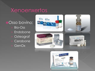 Osso bovino:
› Bio-Oss
› Endobone
› Osteograf
› Cerabone
› GenOx
 