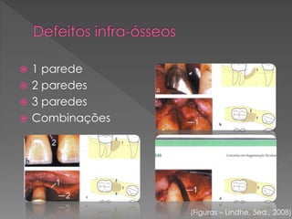  1 parede
 2 paredes
 3 paredes
 Combinações
(Figuras – Lindhe, 5ed., 2008)
 