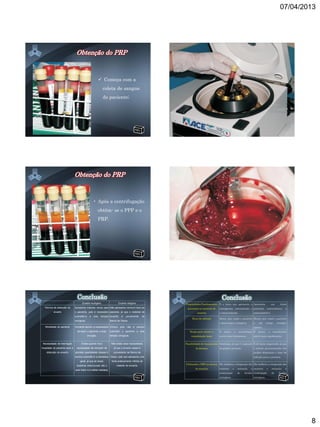 07/04/2013




                                                            Começa com a
                                                             coleta de sangue
                                                             do paciente;




                                                    • Após a centrifugação
                                                           obtêm- se o PPP e o
                                                           PRP.




                                       Enxerto Autógeno                       Enxerto Alógeno          Propriedades Fundamentais É o único que apresenta a Apresenta                          um      ótimo
  Técnica de obtenção do        Apresenta maiores riscos para Não apresenta nenhum risco ao             presentes no material de   osteogênese, osteoindução e potencial              osteoindutivo       e
          enxerto               o paciente, pois é necessário paciente, já que o material de                    enxertia           a osteocondução.                    osteocondutivo.
                                submetê-lo      a   dois    tempos enxertia     é   proveniente   de
                                                                                                            Risco de infecção      Maior, pois expõe o paciente Menor, pois expõe o paciente
                                cirúrgicos.                        Banco de Ossos.
                                                                                                                                   a dois tempos cirúrgicos.           a   um        tempo         cirúrgico
   Morbidade do paciente        Aumenta devido a necessidade Diminui pois não é preciso                                                                                apenas.
                                  de expor o paciente a duas       submeter o paciente a dois             Tempo para ocorrer a     É   maior,         a   remodelação É    menor,         a   remodelação
                                              cirurgias.           tempos cirúrgicos.                      remodelação óssea       ocorre mais lentamente.             ocorre mais rapidamente.


Necessidade de internação             Existe quando há a            Não existe essa necessidade,       Possibilidade de transmissão Nenhuma, já que é originado É de baixa magnitude, já que
hospitalar do paciente para a    necessidade de remoção de             já que o enxerto ósseo é                de doenças          do próprio paciente.                o correto processamento dos
    obtenção do enxerto         grandes quantidades ósseas é           proveniente de Banco de                                                                         tecidos diminuem o risco de
                                preciso submetê-lo a anestesia Ossos, este que apresenta uma                                                                           infecção para o paciente.
                                     geral, já que as áreas          fonte praticamente infinita de
                                                                                                       Utilizando o PRP na técnica Ele melhora a integração dos Ele melhora a integração dos
                                 doadoras extra-bucais são o             material de enxertia.
                                                                                                               de enxertia         enxertos       e       estimula   a enxertos       e       estimula    a
                                osso ilíaco e a calota craniana.
                                                                                                                                   cicatrização           de   feridas cicatrização           de    feridas
                                                                                                                                   cirúrgicas.                         cirúrgicas.




                                                                                                                                                                                                               8
 