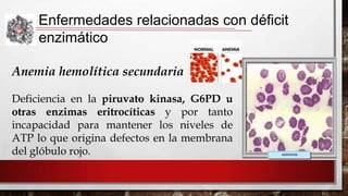 Enfermedades relacionadas con déficit
enzimático
Anemia hemolítica secundaria
Deficiencia en la piruvato kinasa, G6PD u
otras enzimas eritrocíticas y por tanto
incapacidad para mantener los niveles de
ATP lo que origina defectos en la membrana
del glóbulo rojo.

 