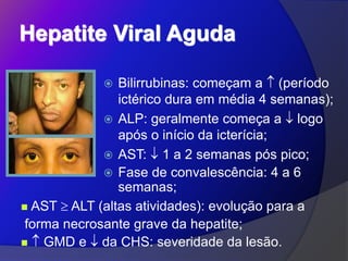 Hepatite Viral Aguda
 Bilirrubinas: começam a  (período
ictérico dura em média 4 semanas);
 ALP: geralmente começa a  logo
após o início da icterícia;
 AST:  1 a 2 semanas pós pico;
 Fase de convalescência: 4 a 6
semanas;
 AST  ALT (altas atividades): evolução para a
forma necrosante grave da hepatite;
  GMD e  da CHS: severidade da lesão.
 