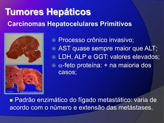Tumores Hepáticos
Carcinomas Hepatocelulares Primitivos
 Processo crônico invasivo;
 AST quase sempre maior que ALT;
 LDH, ALP e GGT: valores elevados;
 -feto proteína: + na maioria dos
casos;
 Padrão enzimático do fígado metastático: varia de
acordo com o número e extensão das metástases.
 