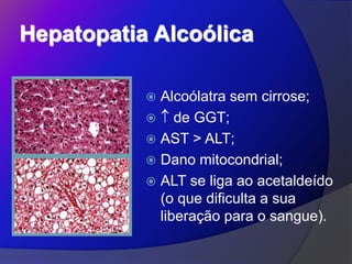Hepatopatia Alcoólica
 Alcoólatra sem cirrose;
  de GGT;
 AST > ALT;
 Dano mitocondrial;
 ALT se liga ao acetaldeído
(o que dificulta a sua
liberação para o sangue).
 