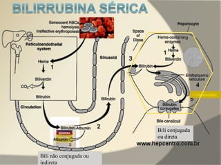 Bili não conjugada ou
indireta
+ Glicuronídeo
Bili conjugada
ou direta
 