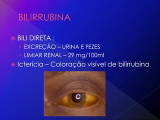  BILI DIRETA :
› EXCREÇÃO – URINA E FEZES
› LIMIAR RENAL – 29 mg/100ml
 Icterícia – Coloração visível de bilirrubina
 