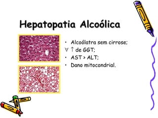 Hepatopatia AlcoólicaHepatopatia Alcoólica
• Alcoólatra sem cirrose;
∀ ↑ de GGT;
• AST > ALT;
• Dano mitocondrial.
 