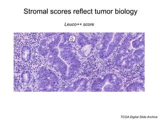 Stromal scores reflect tumor biology
Triple high score
TCGA Digital Slide Archive
 