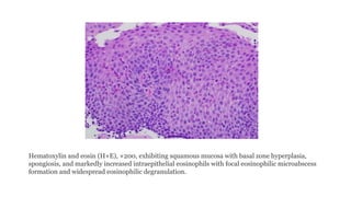 Eosinophilic Esophagitis: Criteria of Diagnosis and Management | PPTX