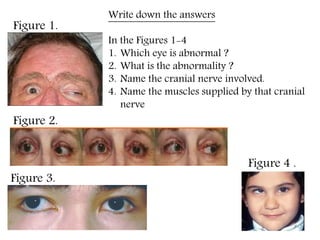 Figure 1.
Figure 2.
Figure 3.
Figure 4 .
Write down the answers
In the Figures 1-4
1. Which eye is abnormal ?
2. What is the abnormality ?
3. Name the cranial nerve involved.
4. Name the muscles supplied by that cranial
nerve
 