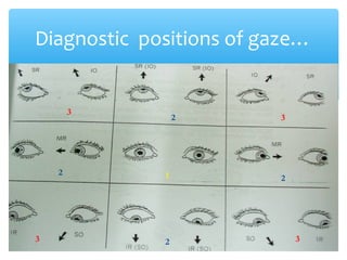 Diagnostic positions of gaze…
2 1 2
2
2
3
3
3
3
 