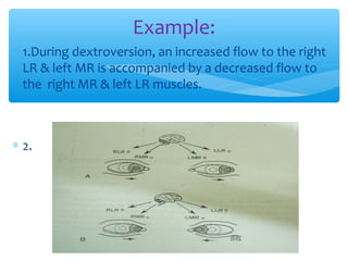 ∗ 1.During dextroversion, an increased flow to the right
LR & left MR is accompanied by a decreased flow to
the right MR & left LR muscles.
∗ 2.
Example:
 