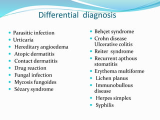 Differential diagnosis
 Parasitic infection
 Urticaria
 Hereditary angioedema
 Atopic dermatitis
 Contact dermatitis
 Drug reaction
 Fungal infection
 Mycosis fungoides
 Sézary syndrome
 Behçet syndrome
 Crohn disease
Ulcerative colitis
 Reiter syndrome
 Recurrent apthous
stomatitis
 Erythema multiforme
 Lichen planus
 Immunobullous
disease
 Herpes simplex
 Syphilis
 