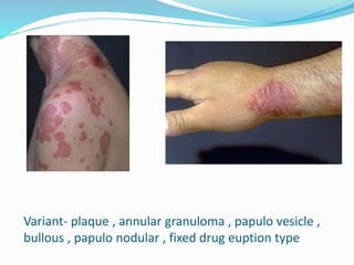 Variant- plaque , annular granuloma , papulo vesicle ,
bullous , papulo nodular , fixed drug euption type
 