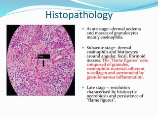 Histopathology
 Acute stage--dermal oedema
and masses of granulocytes
mainly eosinophils.
 Subacute stage--dermal
eosinophils and histiocytes
around angular, focal, fibrinoid
masses. The "flame figures" were
composed of granules,
eosinophilic material adherent
to collagen and surrounded by
granulomatous inflammation.
 Late stage -- resolution
characerised by histiocytic
necrobiosis and persistence of
"flame figures".
 