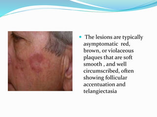  The lesions are typically
asymptomatic red,
brown, or violaceous
plaques that are soft
smooth , and well
circumscribed, often
showing follicular
accentuation and
telangiectasia
 