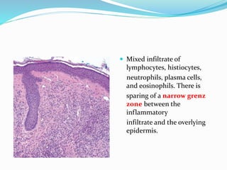  Mixed infiltrate of
lymphocytes, histiocytes,
neutrophils, plasma cells,
and eosinophils. There is
sparing of a narrow grenz
zone between the
inflammatory
infiltrate and the overlying
epidermis.
 