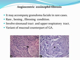 Angiocentric eosinophil fibrosis
 It may accompany granuloma faciale in rare cases.
 Rare , bening , fibrosing condition.
 Involve sinonasal tract and upper respiratory tract.
 Variant of mucosal counterpart of GA.
 