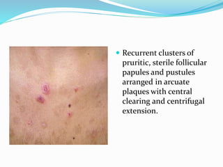  Recurrent clusters of
pruritic, sterile follicular
papules and pustules
arranged in arcuate
plaques with central
clearing and centrifugal
extension.
 